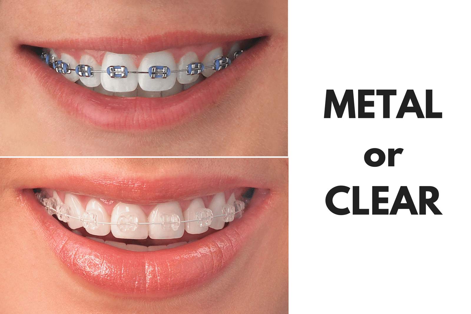 Ask Your Corpus Christi Dentist: Should I Get Metal or Clear Braces?