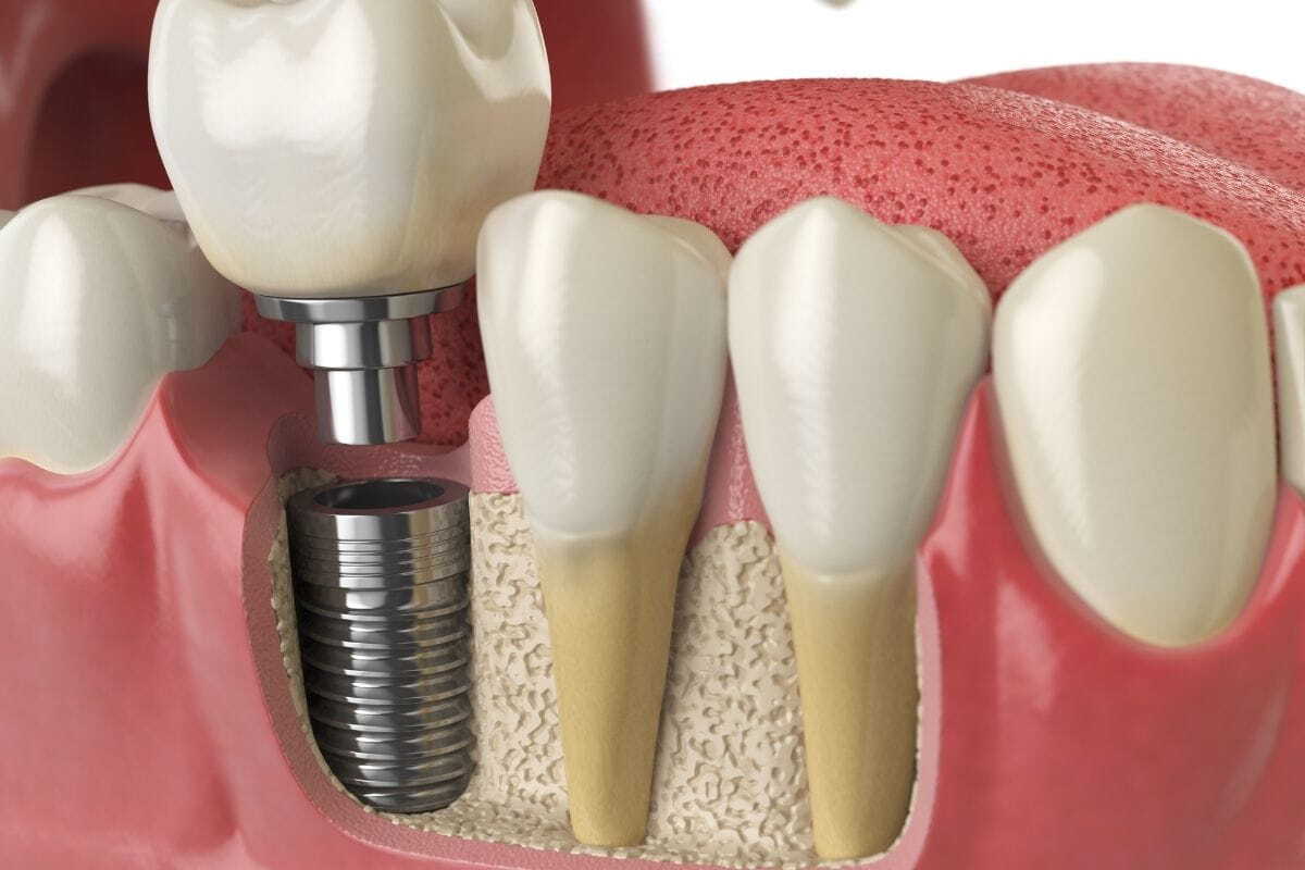 Dental implant diagram showing titanium screw fixture in jawbone with crown restoration.