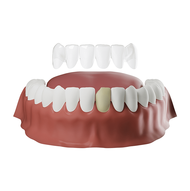 Snap-On Smile veneer showing upper and lower tooth replacement with one discolored tooth before whitening.