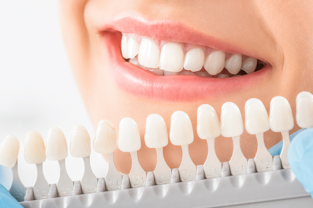 Woman smiling with bright white teeth next to a dental shade guide showing whitening options.