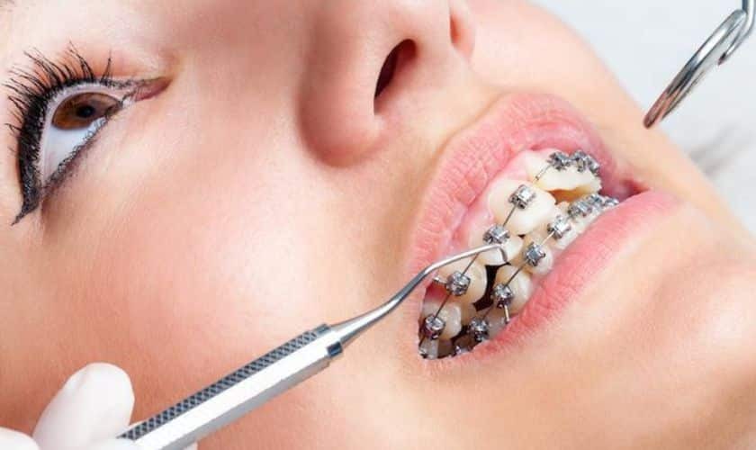 Close-up of orthodontist adjusting metal braces on patient's teeth with dental tools.