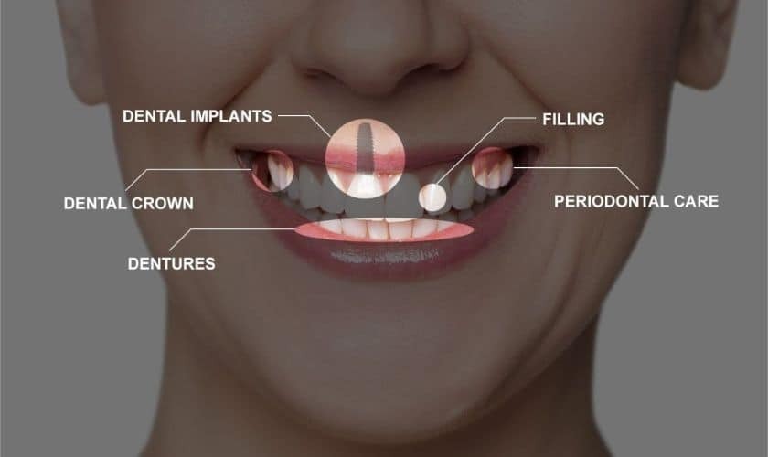 Diagram showing full mouth restoration options including dental implants, crowns, fillings, dentures, and periodontal care.