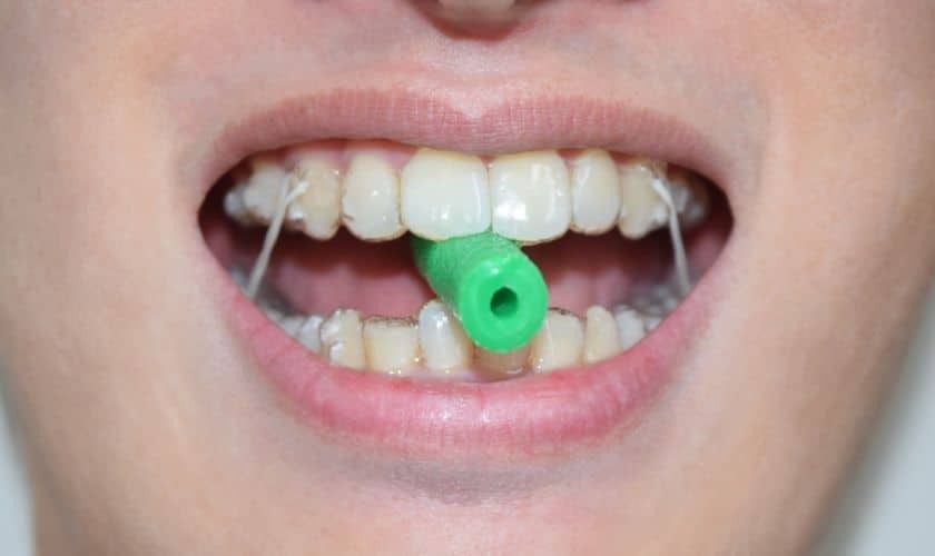 Patient using a green Invisalign chewie to seat aligners on upper and lower teeth.