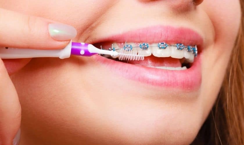 Person brushing teeth with braces using a purple electric toothbrush for proper orthodontic care.