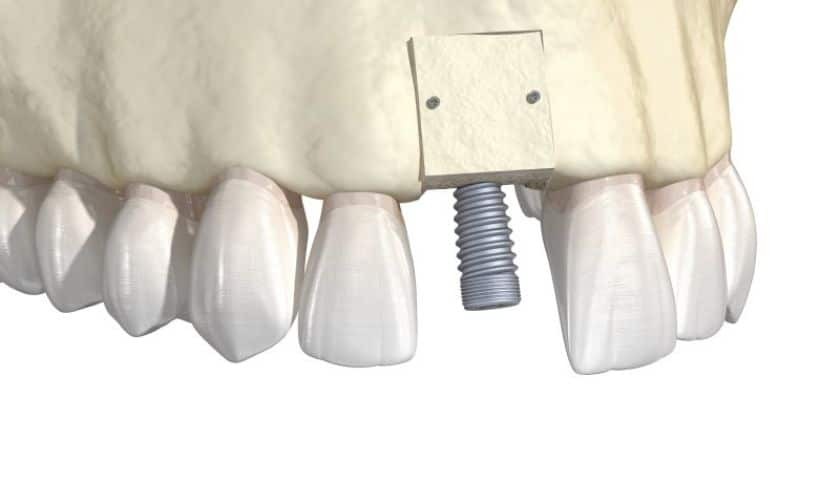 Dental implant with titanium screw placed in jawbone among natural teeth.
