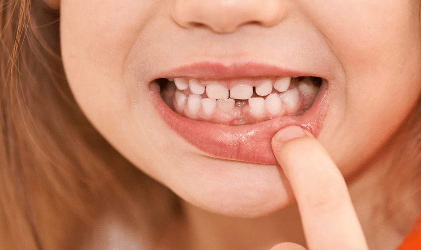 Child pointing to gap between front teeth showing diastema requiring dental implant.