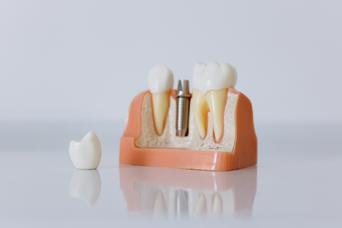Dental implant model showing titanium screw placement in jawbone with crown restoration.