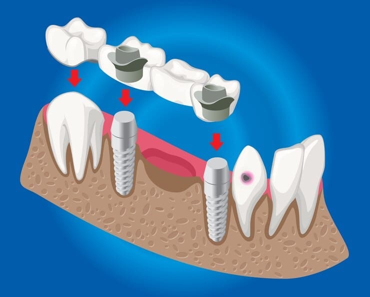 Illustration of dental implants and bridge restoration showing jawbone, implant posts, and crown placement for tooth replace.