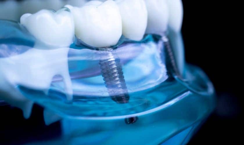 Dental implant model showing titanium screw fixture beneath white prosthetic crown teeth.