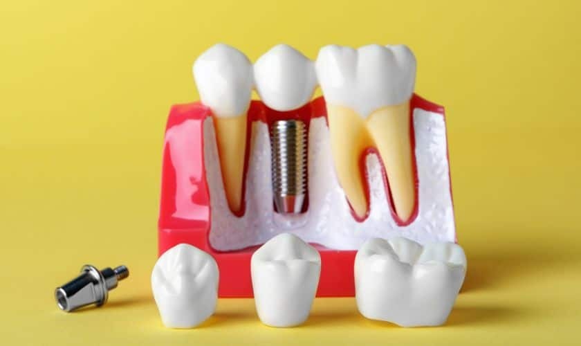 Dental implant model showing tooth replacement with screw-in implant and crown restoration.