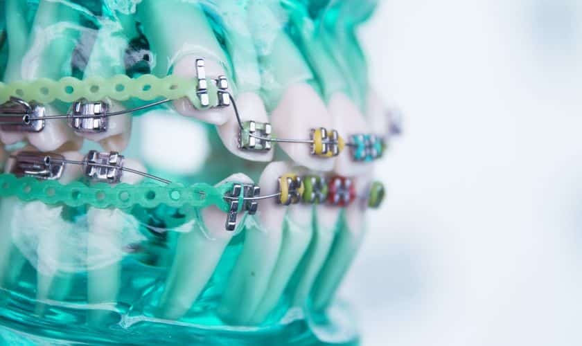 Close-up of orthodontic brackets and wires on dental braces mounted on green background.