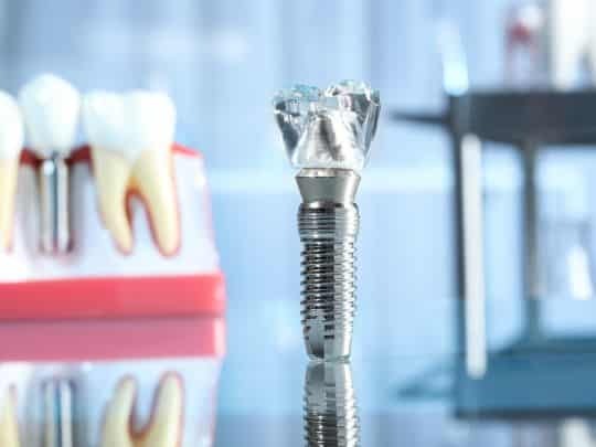 Dental implant screw displayed in a professional dental office setting in Corpus Christi.