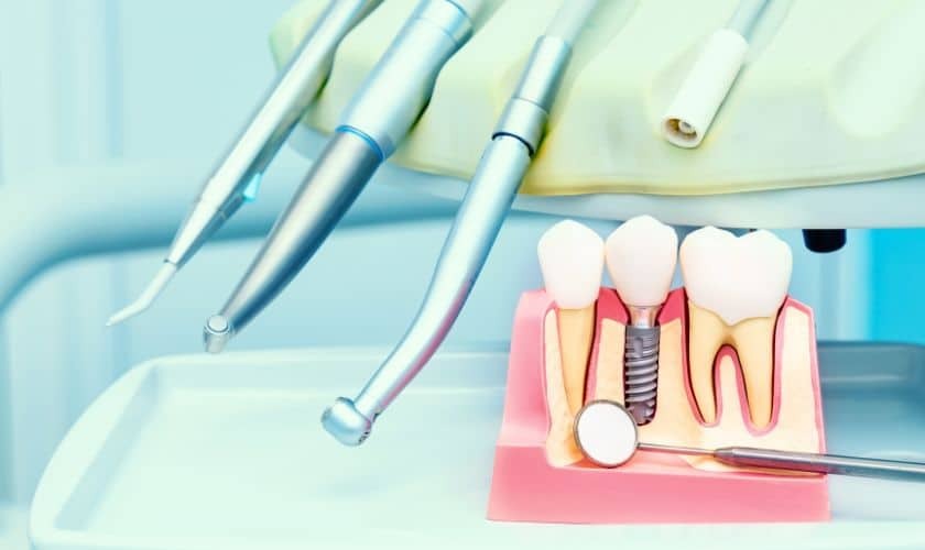 Dental implant model showing tooth replacement options with professional instruments in a Corpus Christi dental office.