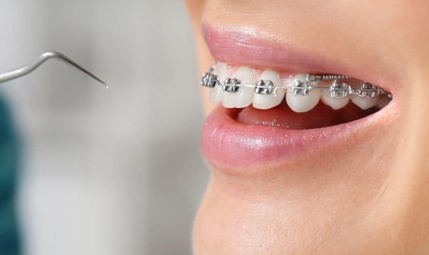 Close-up of a patient's smile showing metal braces on upper teeth during orthodontic treatment.