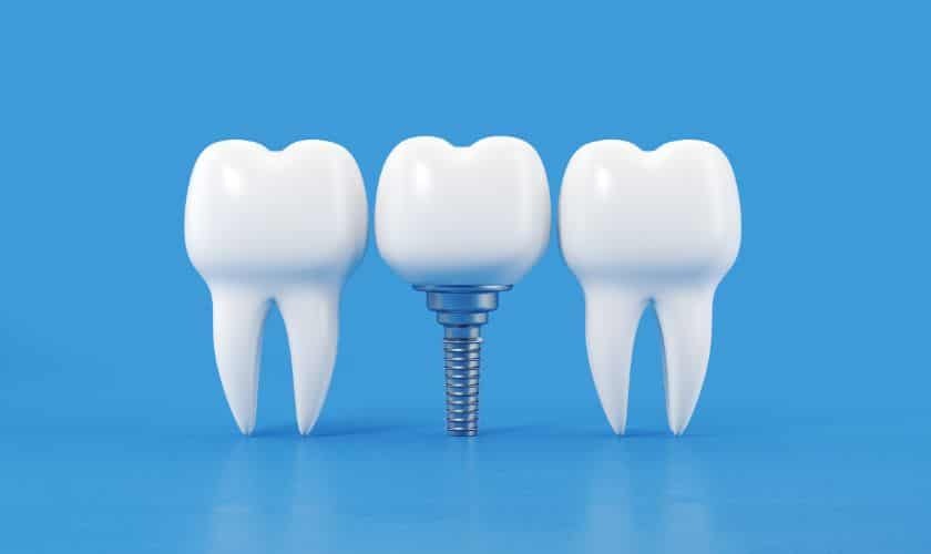 Dental implant illustration showing two natural teeth flanking a titanium implant post with blue abutment.