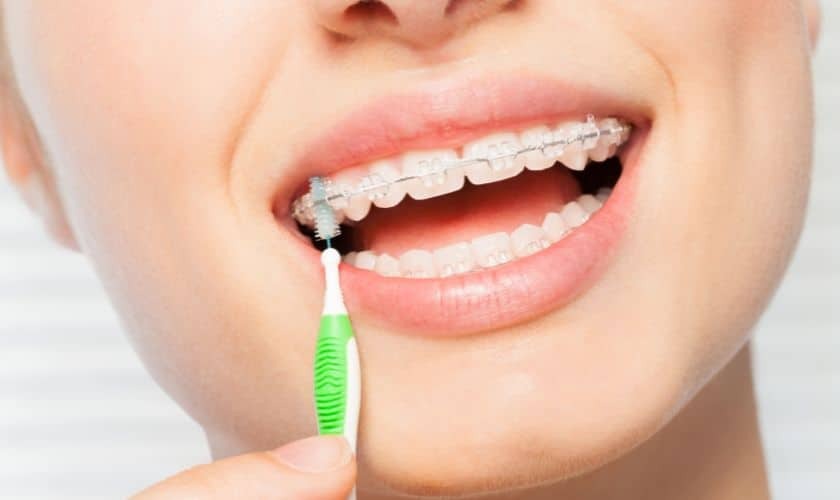 Woman with braces using interdental brush to clean between teeth.