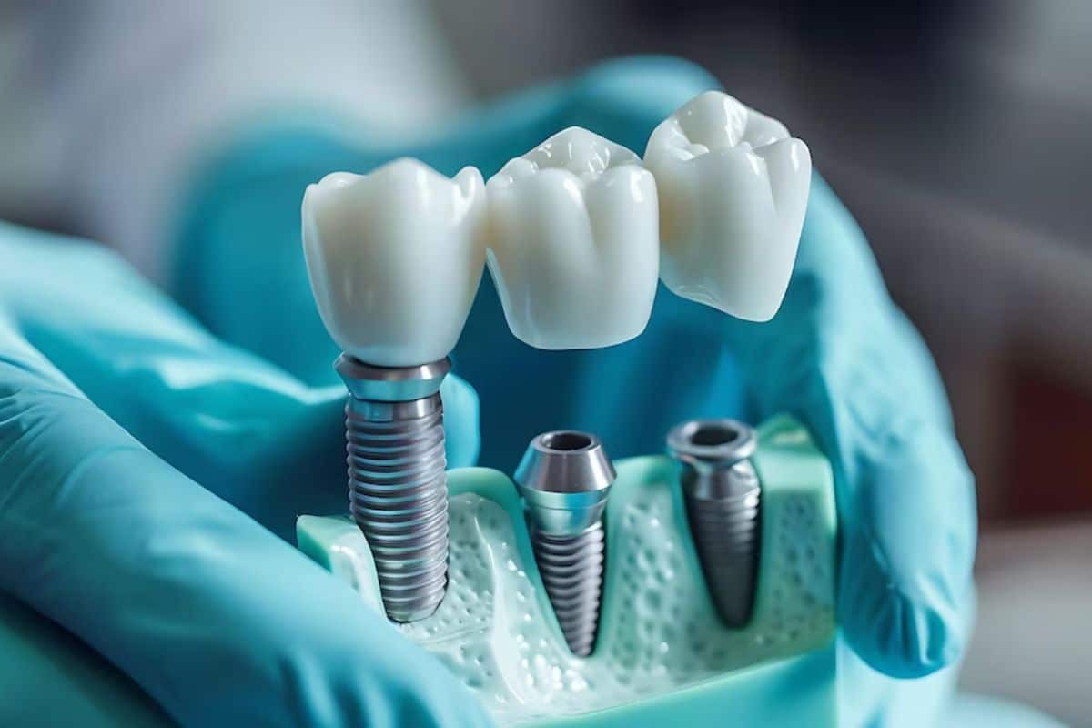 Dental implant demonstration showing three titanium implants and ceramic crowns held in a model jaw.