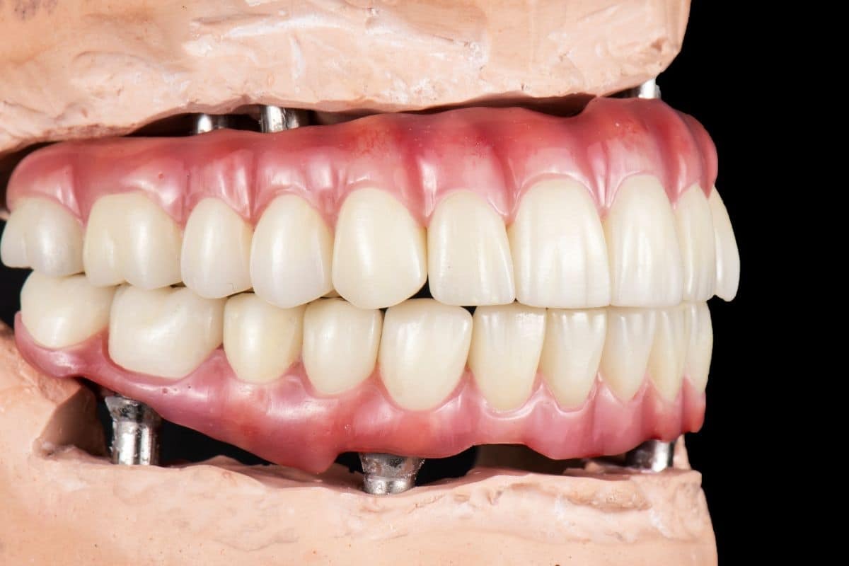 Hybridge implant denture showing full arch restoration with natural-looking ceramic teeth and pink gum prosthetics.