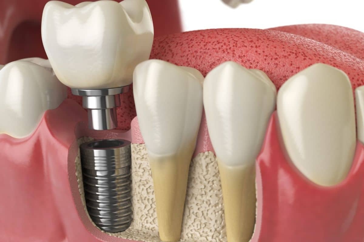 Dental implant diagram showing titanium screw fixture and crown restoration in jawbone.