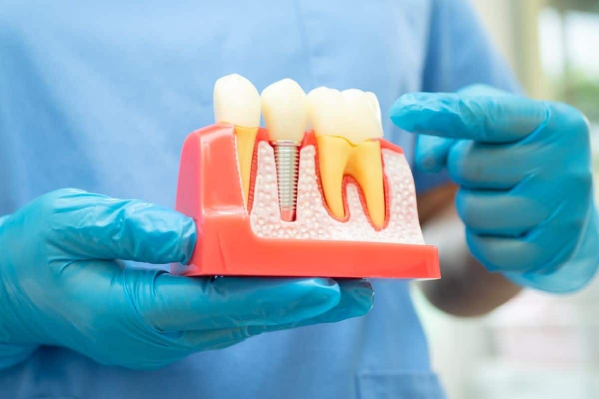 Dentist holding dental implant model showing tooth replacement with implant, abutment, and crown components.
