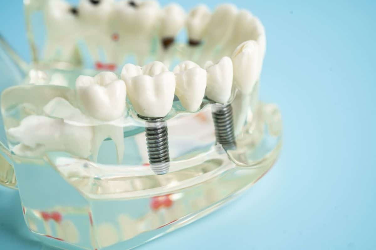 Dental implant model showing tooth replacements with titanium screws anchored in jawbone structure.