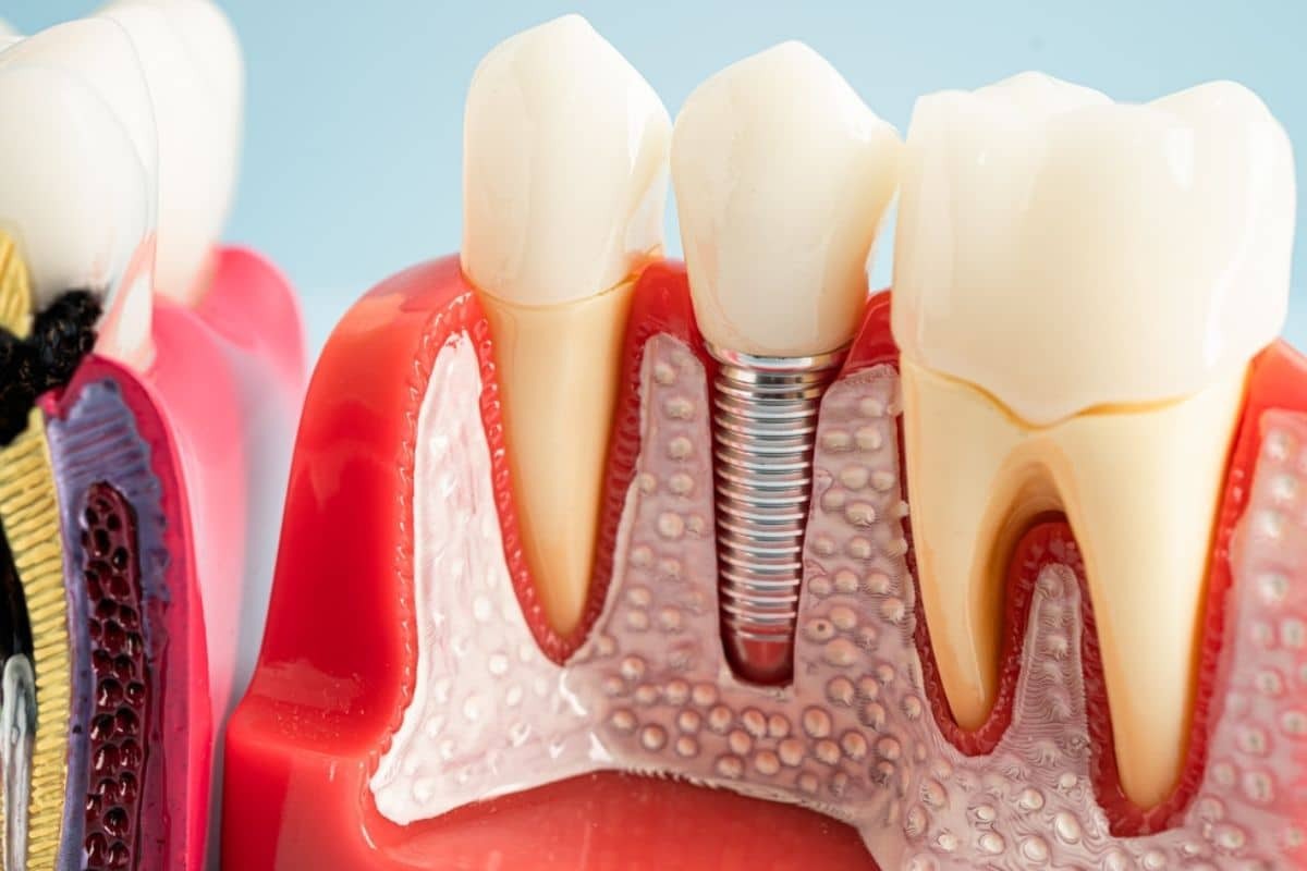 Cross-section diagram showing dental implant placement between natural teeth and gum tissue.