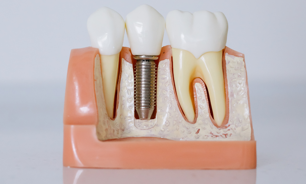 How Long Do Dental Implants Last? A Complete Guide for Corpus Christi Patients