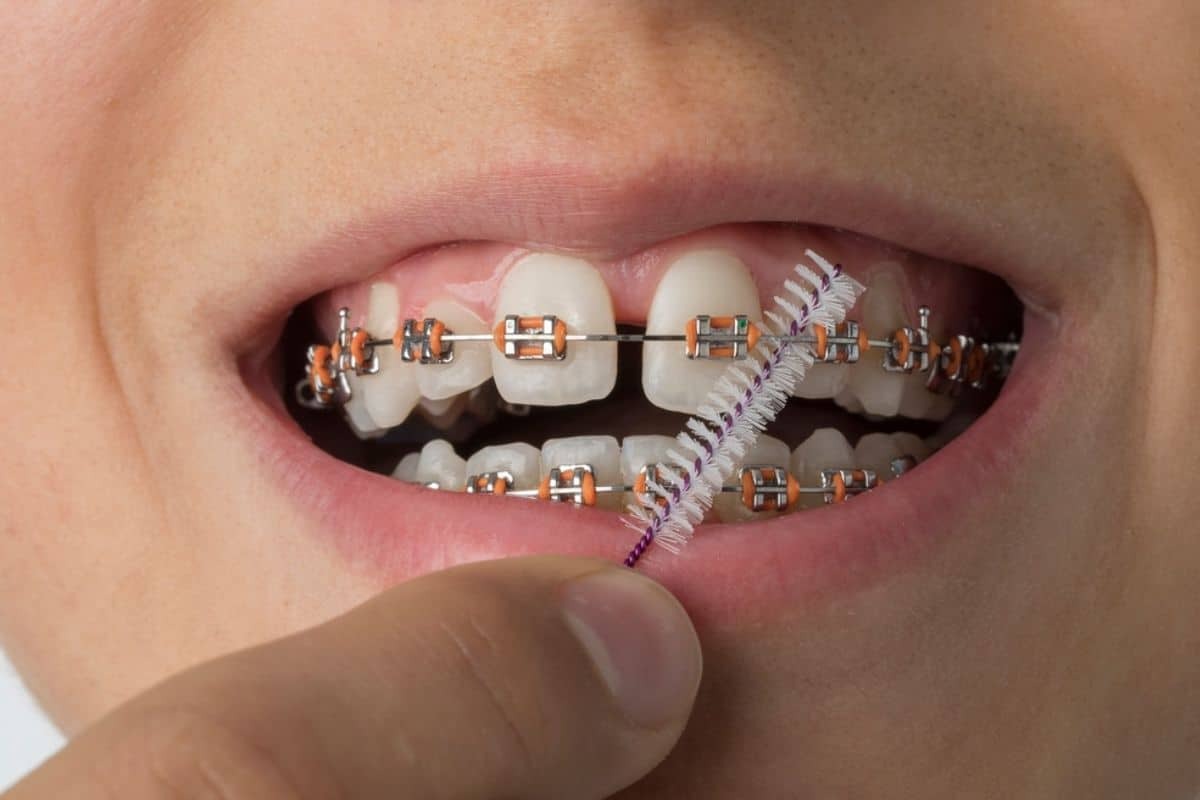 Close-up of teeth with orange and purple metal braces showing orthodontic treatment progress.