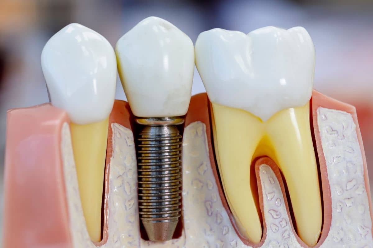 Dental implant cross-section showing titanium screw, crown, and natural tooth comparison for implant treatment.