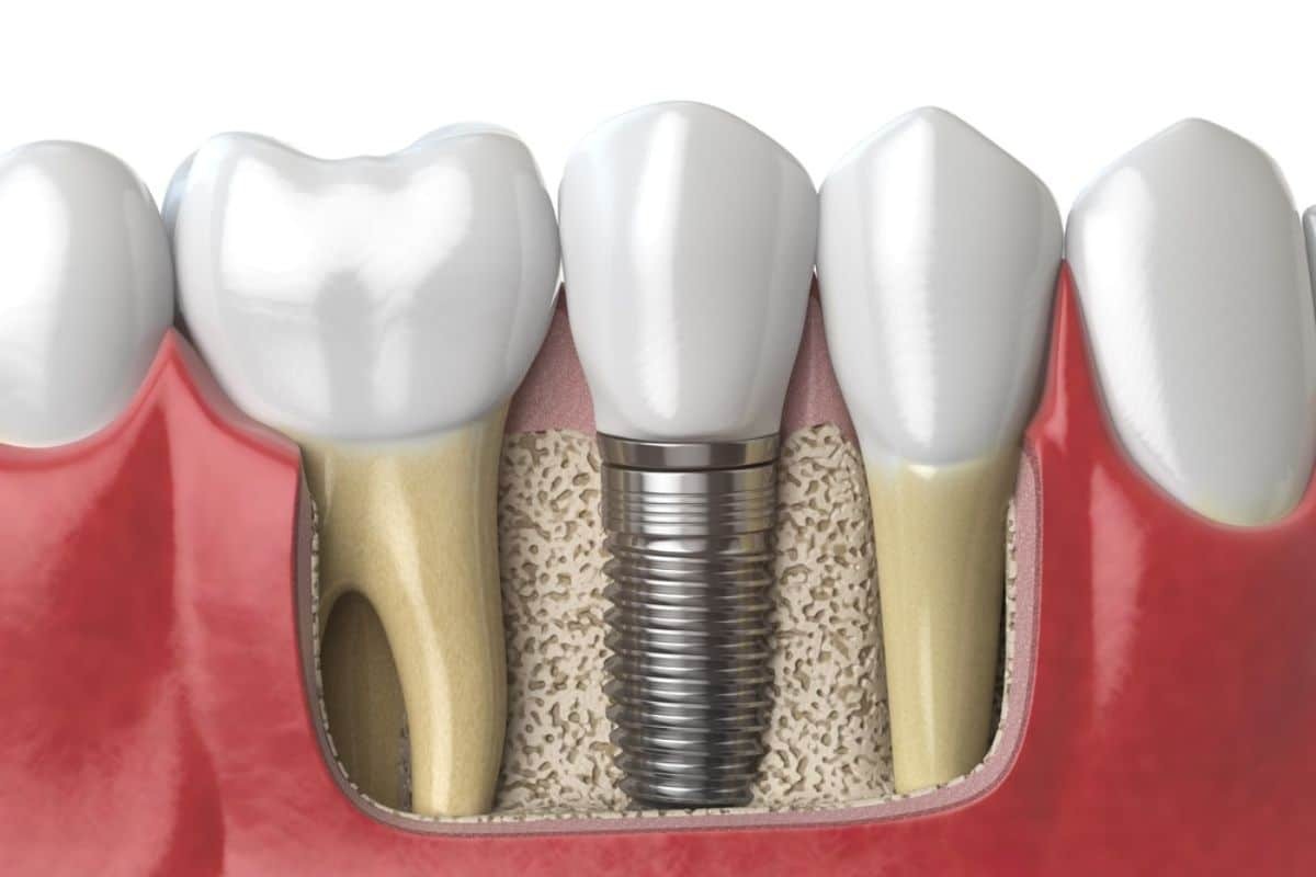 Dental implant cross-section showing titanium screw, bone integration, and ceramic crown restoration.
