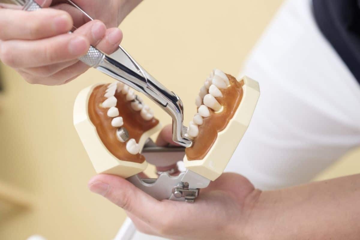 Dentist demonstrating tooth extraction on dental model using forceps during patient education.