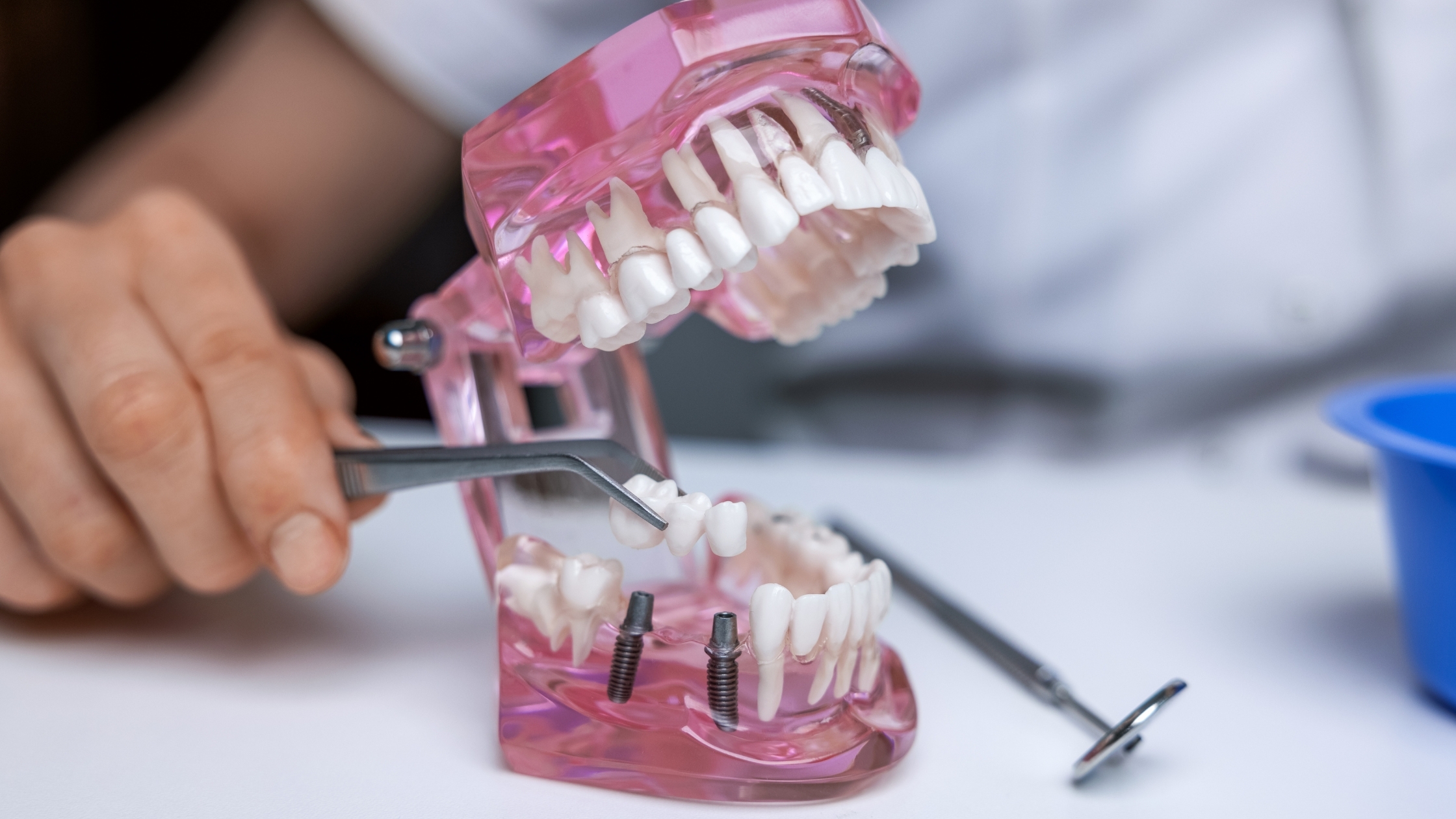 Dental implant model demonstrating tooth restoration with implant posts and prosthetic teeth placement.