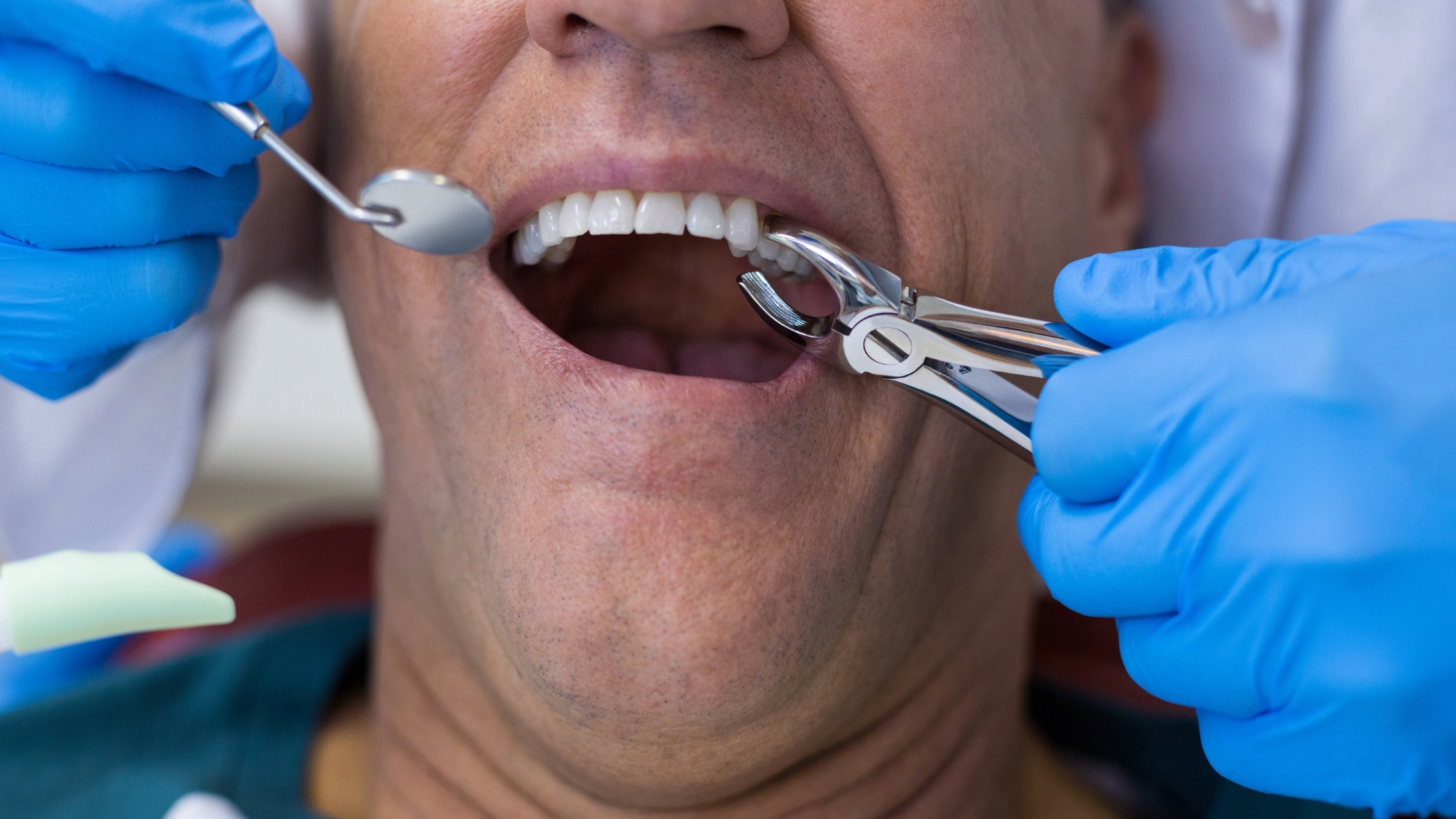 Dentist extracting a tooth using forceps while patient keeps mouth open during dental procedure.