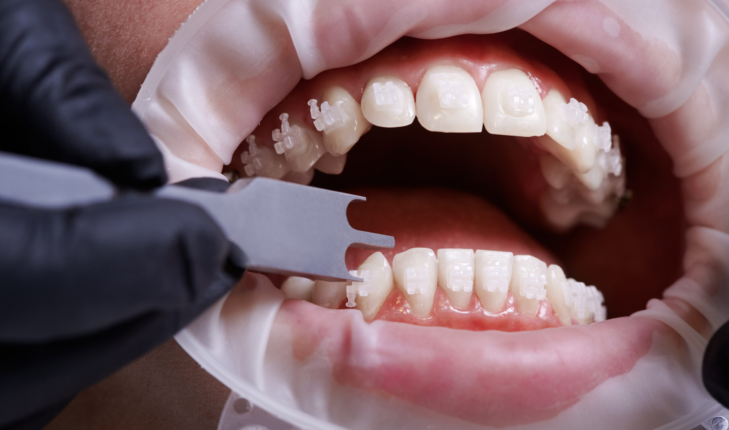 Dental veneer placement being examined during patient consultation and care instruction.