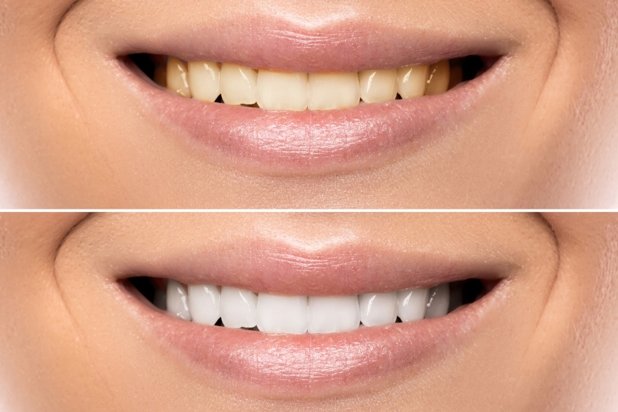 Before and after comparison of teeth whitening treatment results in Corpus Christi.