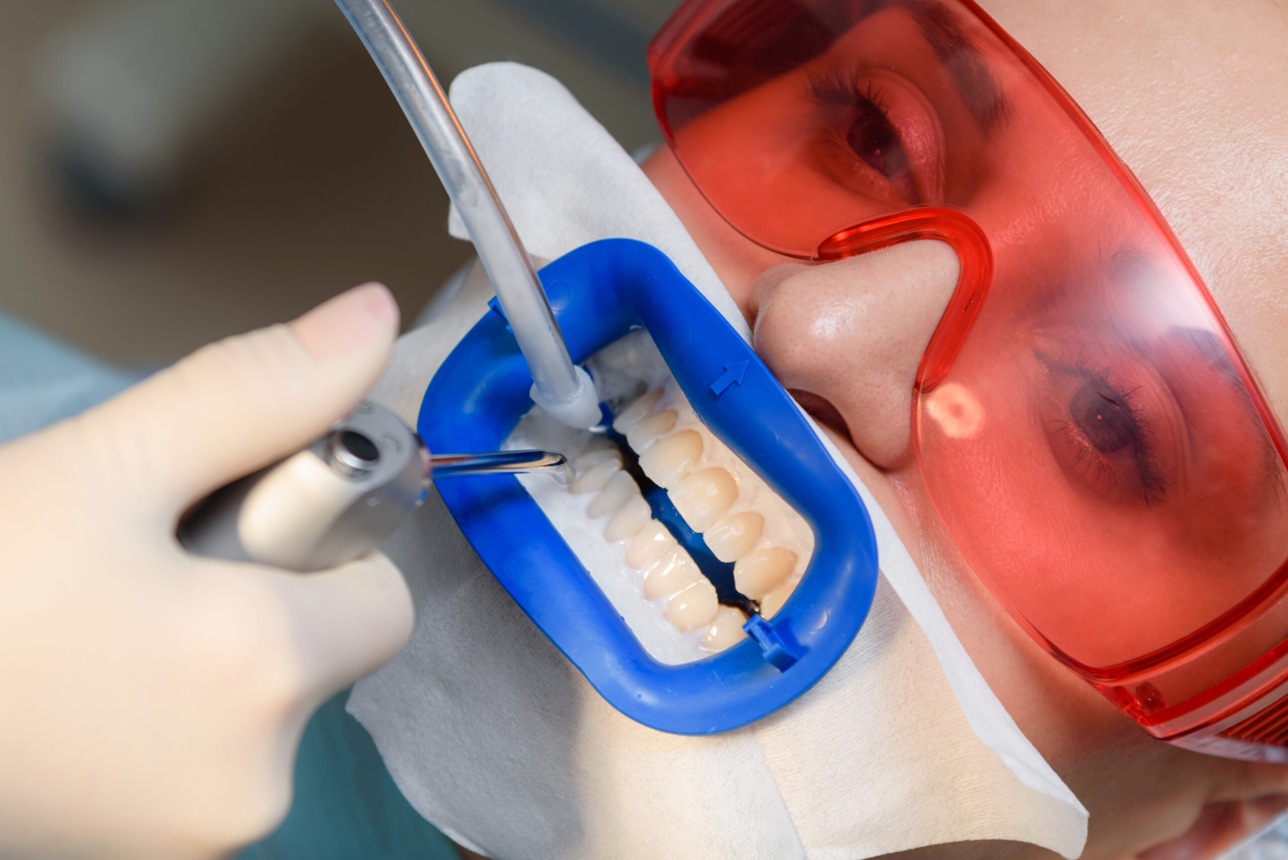Dentist applying composite bonding to upper front teeth using blue shade guide and red protective glasses.