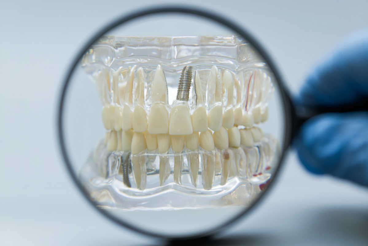 Dental implant model showing prosthetic teeth and screw implant fixture in clear acrylic jaw model.