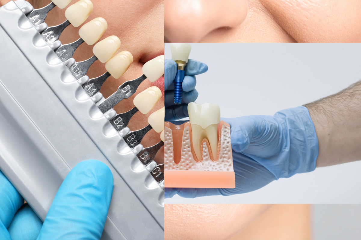 Dental implant shade guide with model showing implant placement and natural tooth comparison for cosmetic dentistry.