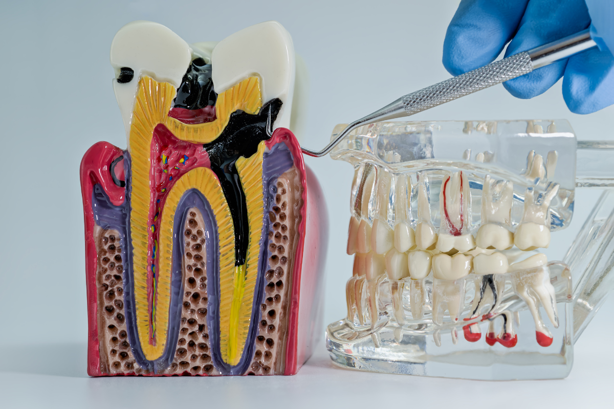 Dental anatomy model showing tooth structure with pulp, nerves, and blood vessels for patient education.