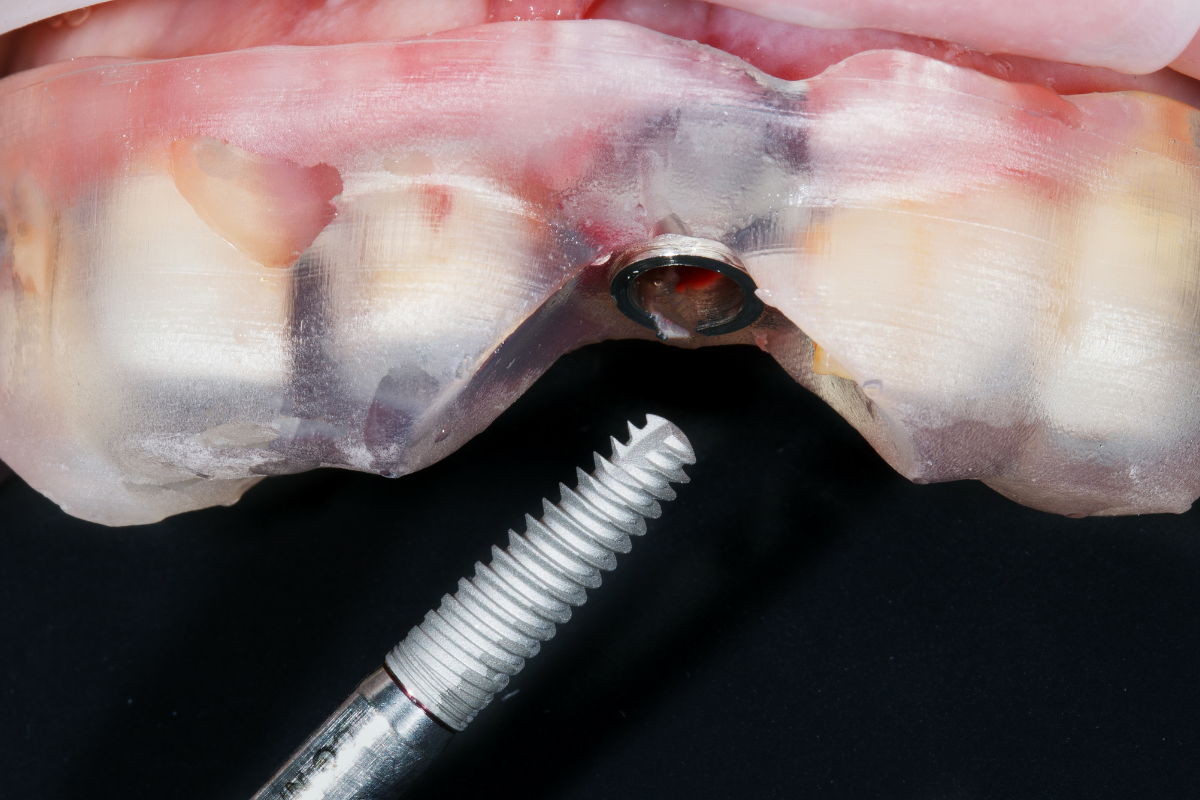 Featured image for “Smoking During Dental Implant Treatment: How It Can Affect Healing and Long-Term Results”