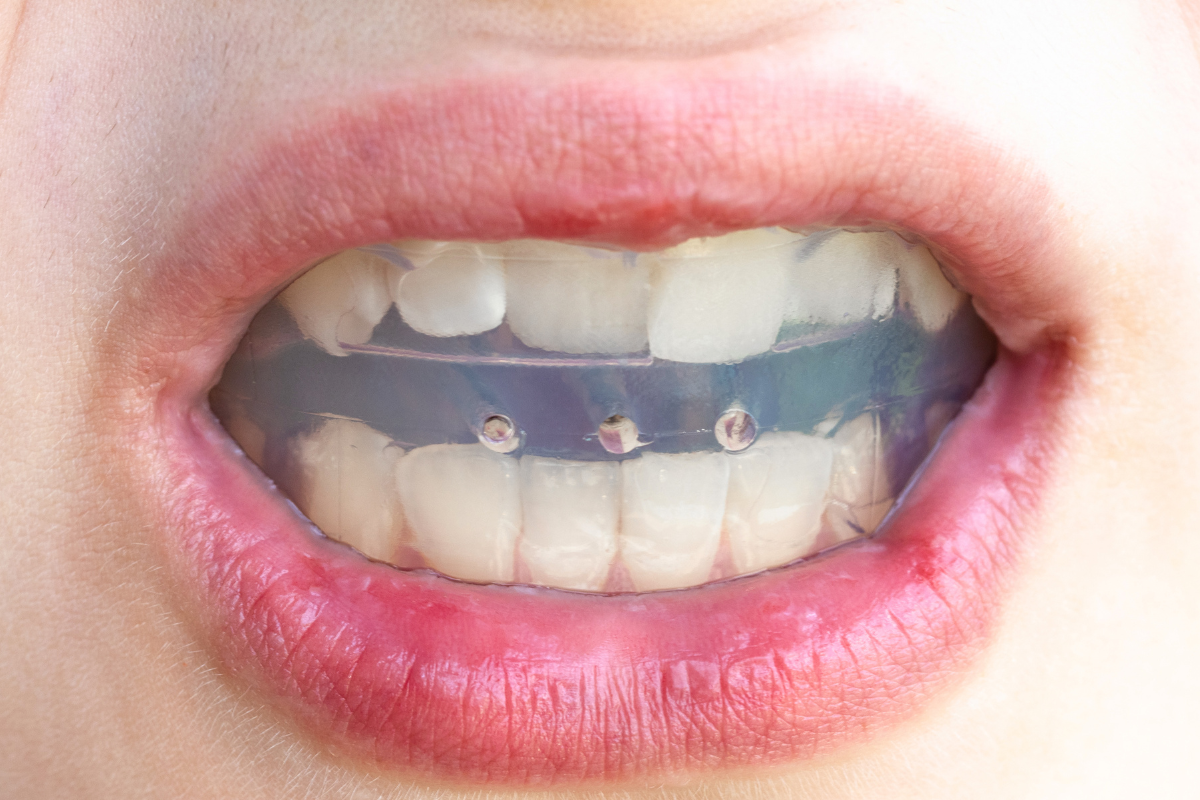 Featured image for “The Long-Term Benefits of Correcting Misaligned Teeth and Bite Problems”
